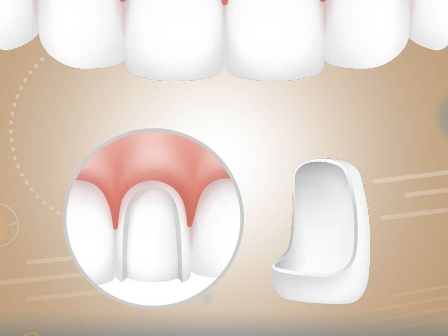 تركيب فينير الاسنان