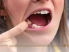 ما هي اضرار عدم خلع الضرس المسوس