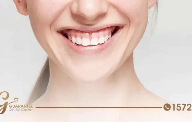 كيفية علاج الابتسامة اللثوية