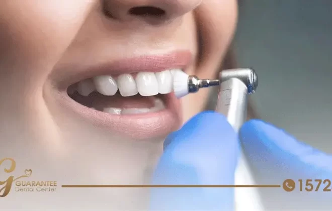 اسعار تنظيف جير الاسنان