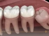 زائدة لحمية فوق ضرس العقل| الأسباب وطرق الوقاية والعلاج