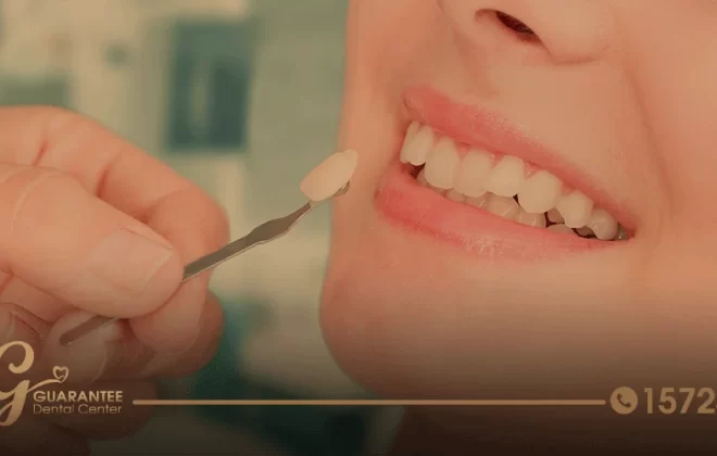 تركيب فينير الأسنان الخطوة الأولى نحو ابتسامة مذهلة