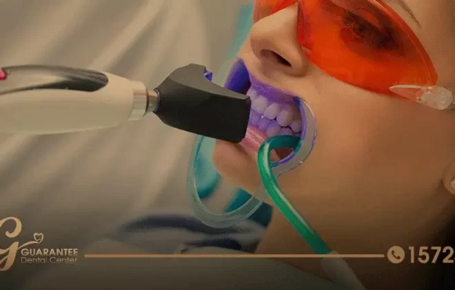 تنظيف الاسنان بالليزر تقنية مبتكرة لصحة وجمال أسنانك