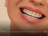 التقويم الشفاف للاسنان