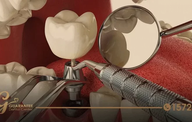 انواع الاسنان التركيب بمركز جرانتي