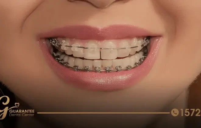تقويم الاسنان الشفاف