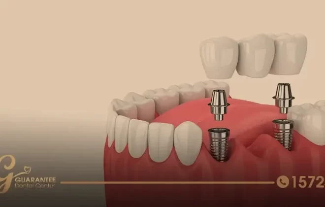 ما هي مدة زراعة الاسنان؟
