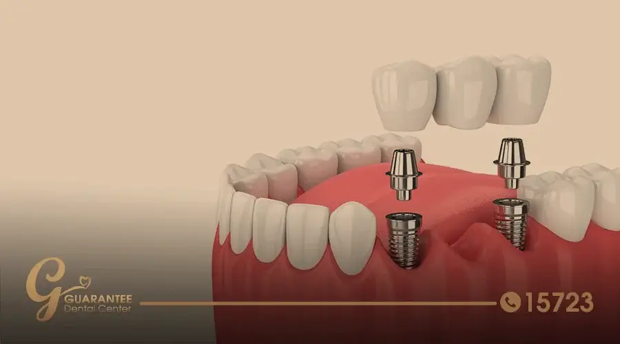ما هي مدة زراعة الاسنان؟