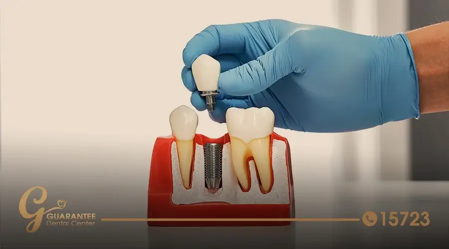 أهمية تركيب اسنان صناعية وأنواعها