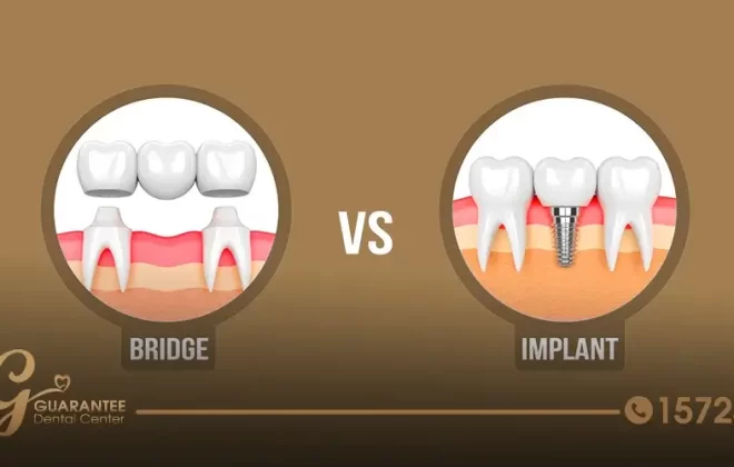 ايهما افضل زراعة الاسنان ام التركيب؟