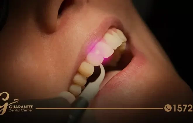 زراعة الاسنان بالليزر فى مصر - و4 نصائح قبل وبعد العملية