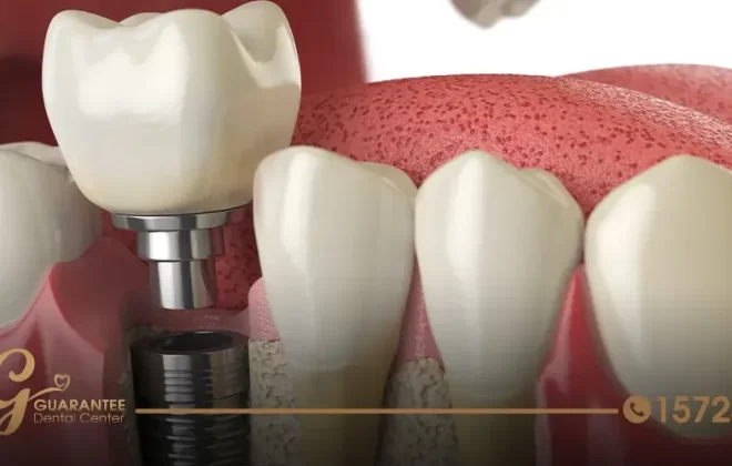 ما هي طريقة زراعة الاسنان الامامية؟