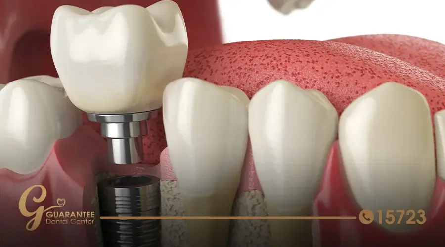 ما هي طريقة زراعة الاسنان الامامية؟