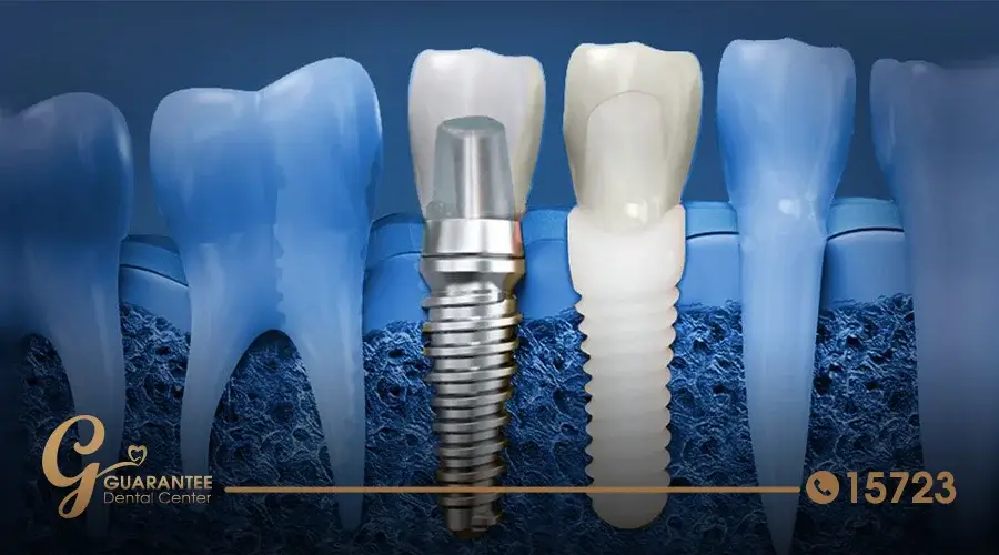 نصائح لما بعد عملية زراعة عظام الاسنان