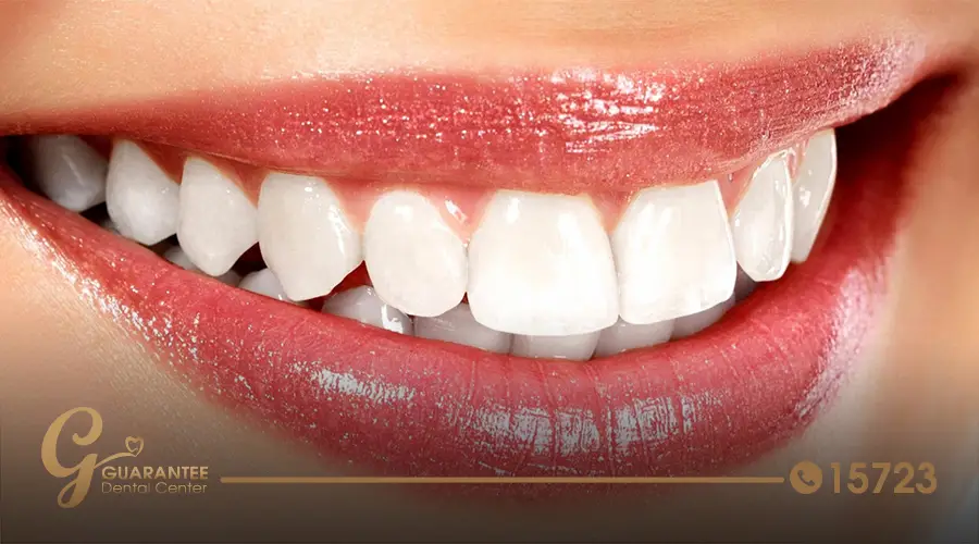 What-are-Hollywood-Smile-Snap-On-Teeth