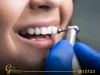 Average Cost Of Teeth Cleaning
