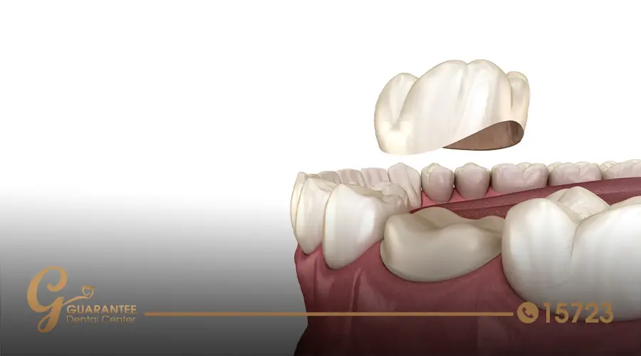 Dental Crown placement