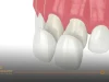 Dental Veneers