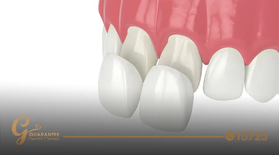 Dental Veneers