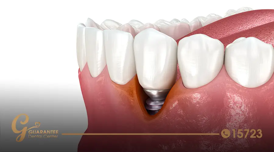 Dental-implant