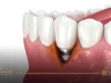 Dental implant