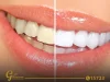Effective Ways to Clean Stains Between Your Teeth