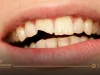 Front teeth filling