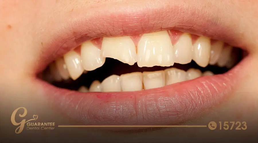 Front teeth filling الموقع الرسمي لعيادات Guarantee dental