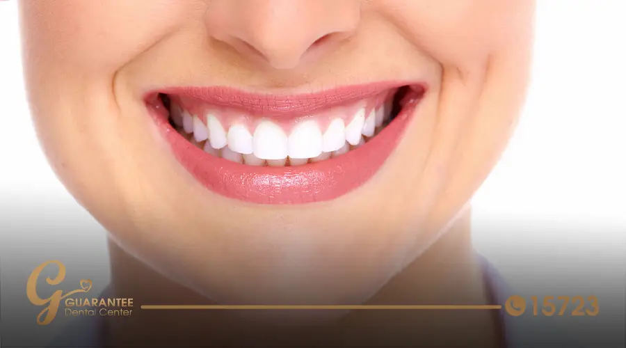 Hollywood Smile
