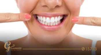 أنواع تجميل الأسنان: الدليل الشامل لاختيار الإجراء المناسب لابتسامة أجمل وأكثر ثقة