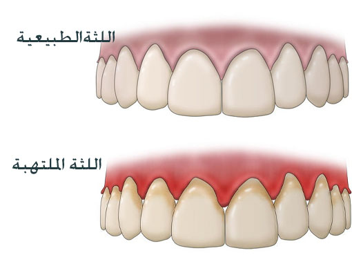 أعراض التهاب اللثة وتورمها حول الأسنان