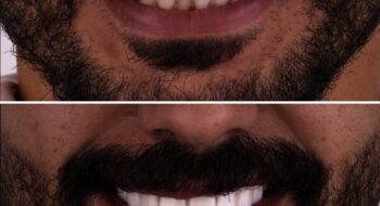 اسعار تبييض الاسنان 2026