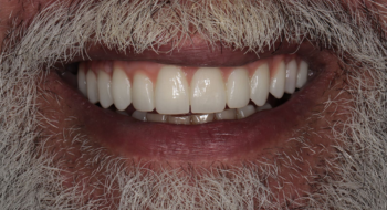 اشكال تسوس الاسنان: دليل شامل لفهم الأنواع والأسباب والعلاج