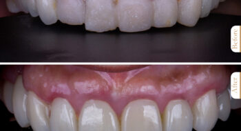 متى تحتاج إلى جراحة تجميل اللثة؟ الدليل الشامل لصحة وجمال الابتسامة