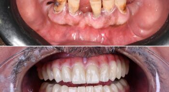 أفضل طريقة للعناية بالأسنان بعد التقويم: دليل شامل لابتسامة صحية تدوم