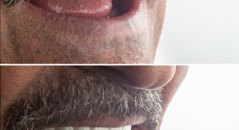 الفرق بين زراعة الأسنان والتركيب الثابت: دليلك الشامل لاختيار الحل الأنسب