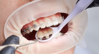 سبب خراج الضرس